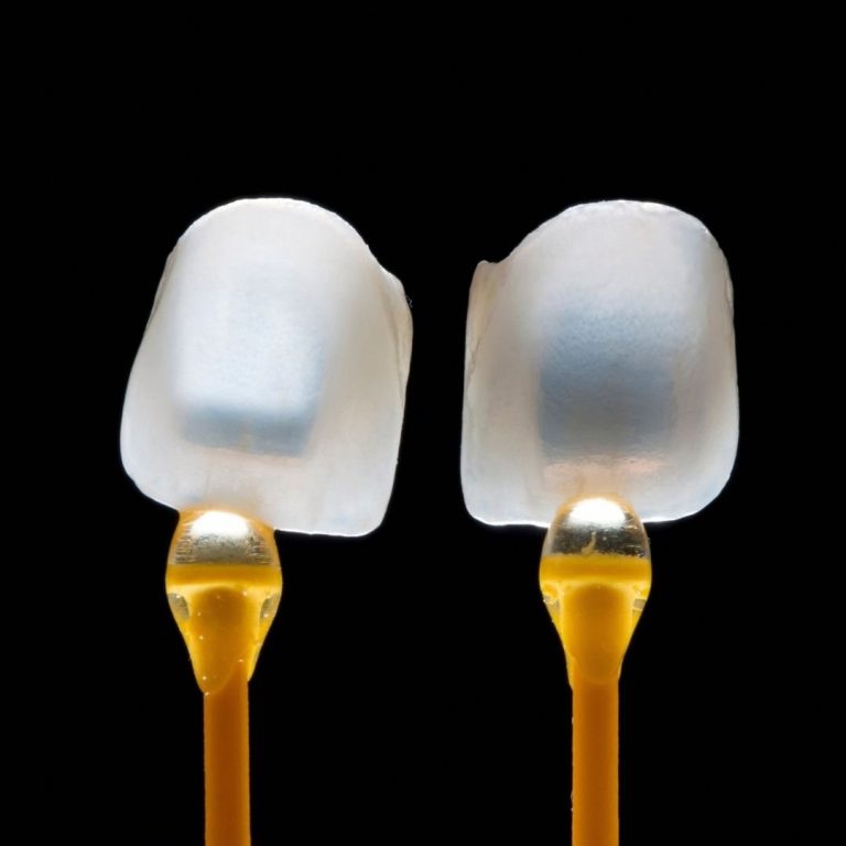 faccette-dentali